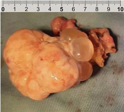 The challenging management of borderline ovarian tumors (BOTs) in women of childbearing age